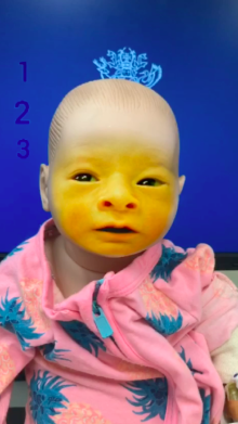Jaundice Simulator